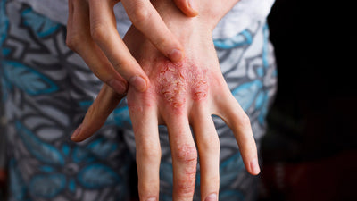 The Eczema Guide: Understanding the triggers